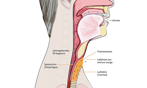 Laryngektomie